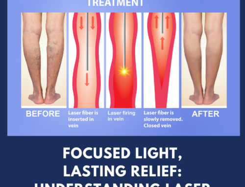 Focused light, Lasting relief: Understanding Laser Ablation for vascular health