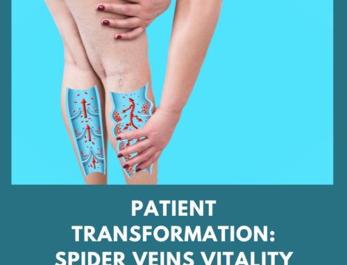 Patient Transformation: Spider Veins Vitality