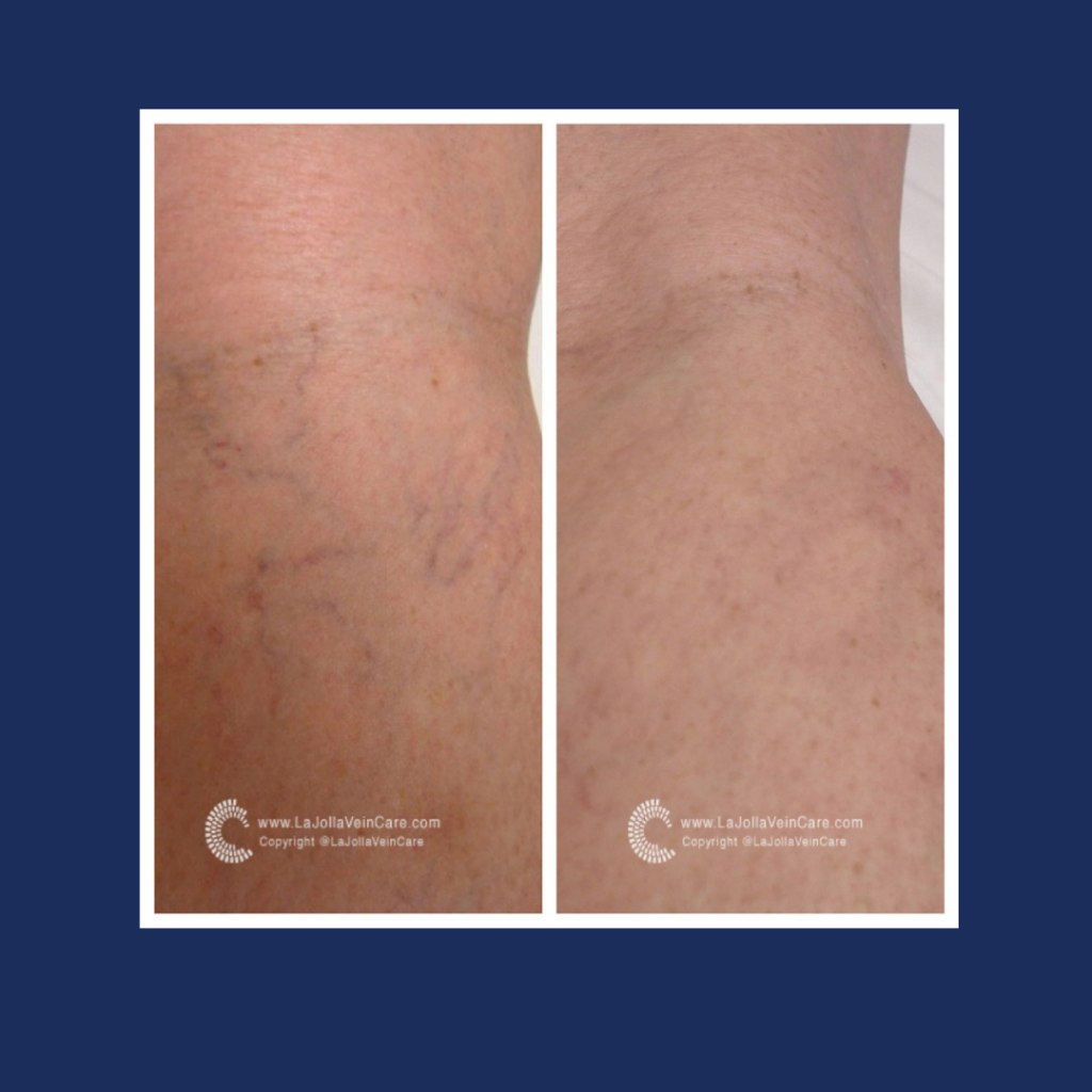 Spider Veins Vitality