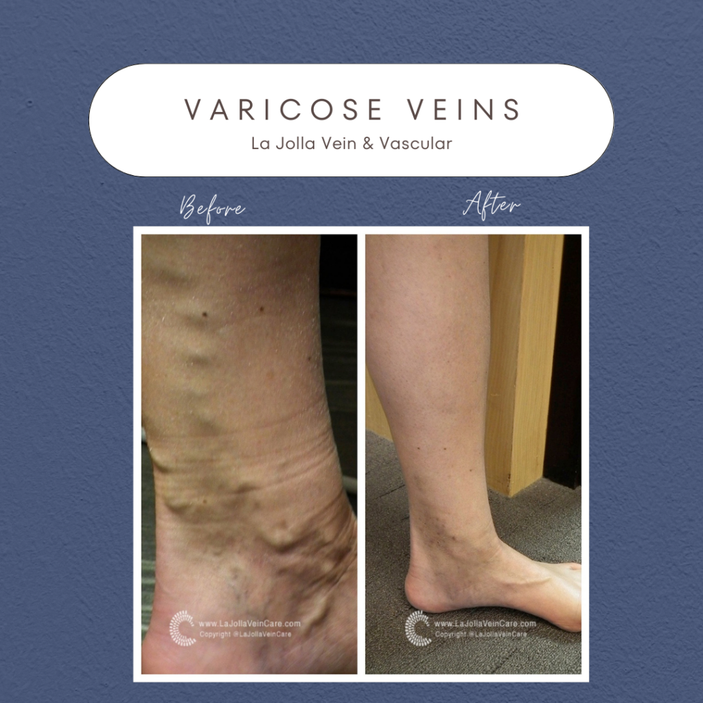 Patient Varicose Veins Transformations - La Jolla Vein & Vascular