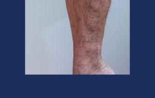 varicose