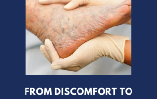 varicose vein