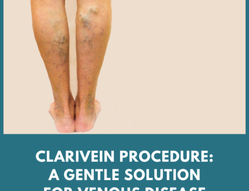 Clarivein Procedure: A Gentle Solution for Venous Disease Relief
