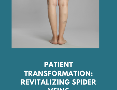 Patient Transformation: Revitalizing Spider Veins