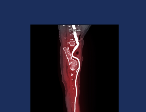 How can I treat Peripheral Arterial Disease?