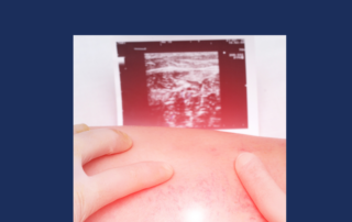 How Do You Know If You Have Deep Vein Thrombosis (DVT)?