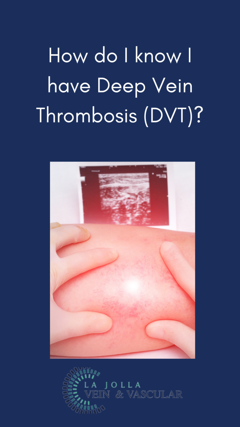 How Do You Know If You Have Deep Vein Thrombosis (DVT)?