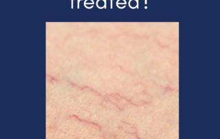 Chronic Venous Insufficiency (CVI) Treatment & Solutions