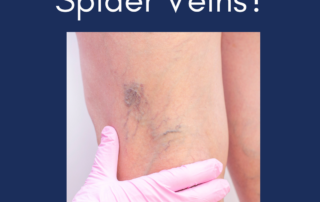 What Do I Need to Know About Removing Spider Veins?