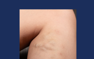 Why Do Varicose Veins Occur? - Understanding Varicose Veins
