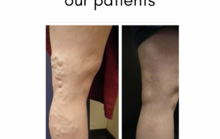 varicose
