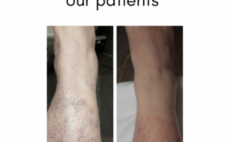 Spider Vein Transformations of Our Patients at La Jolla Vein & Vascular