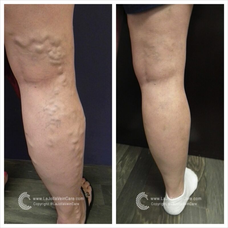 Varicose vein transformations of our patients LJ Vascular