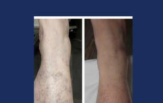 What Are the Least Invasive Ways to Treat Veins?