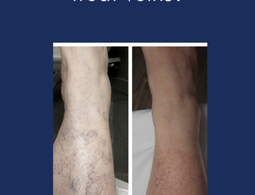 Bruised Varicose Veins: What Are The Risks? - UVVC