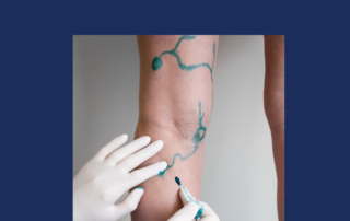 ClariVein® Procedure Treatment | Vein & Vascular Care Clinic