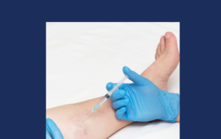 Varithena Injectable Foam Treatment — and What is it?
