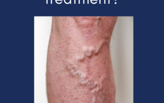 What Will Legs Look Like After Varicose Vein Treatment?