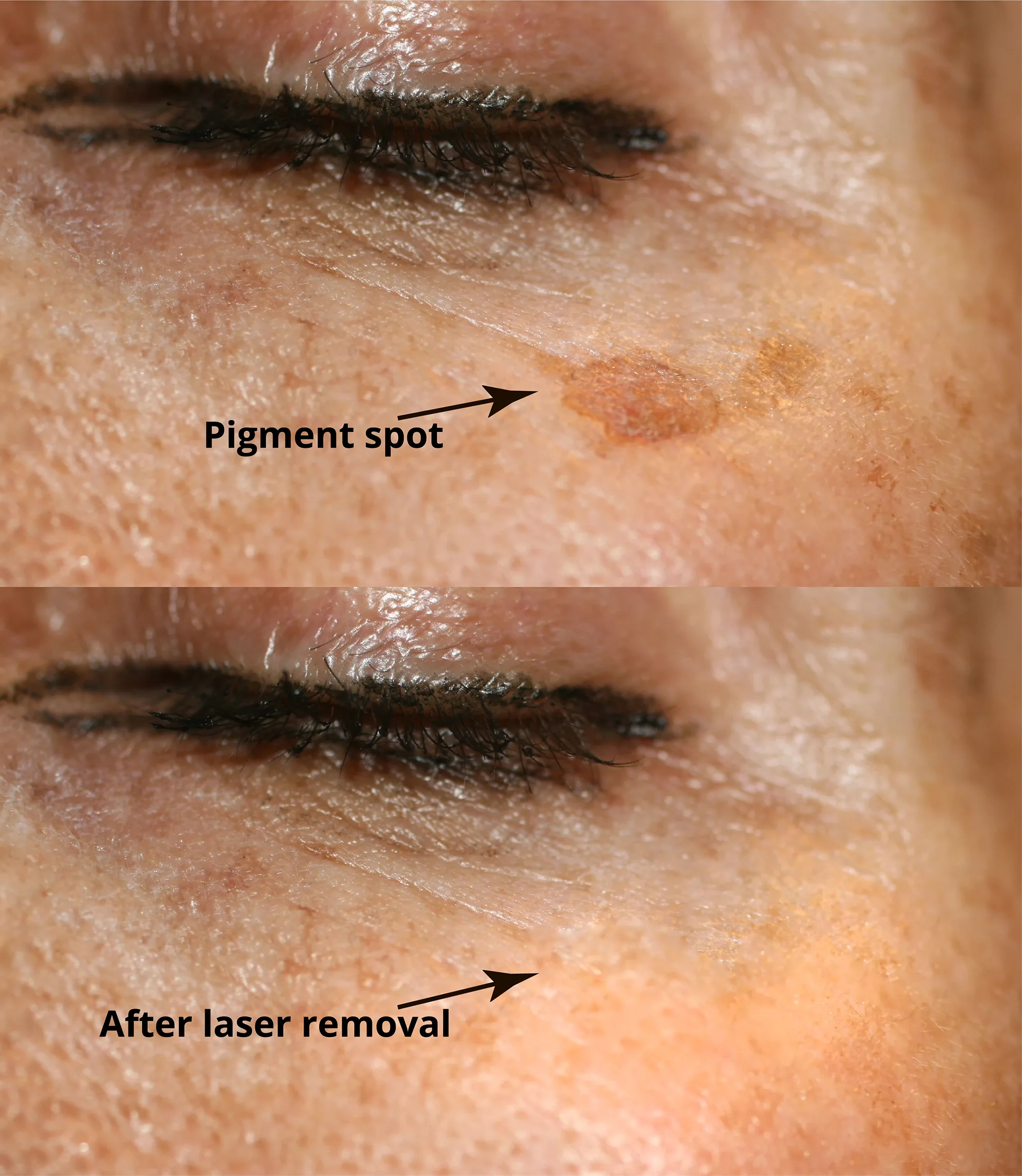 laser removal of brown spots and pigments on face and body