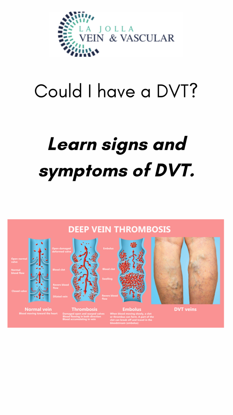 Could I Have a DVT? Learn Signs & Symptoms of Deep Vein Thrombosis