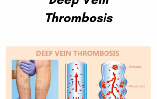 Risk for Deep Venous Thrombosis | Learn DVT Risk Factors