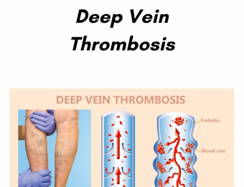 Are you at risk for DVT? Learn your risk factors