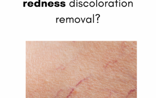 Effective and #1 Blood Vessel & Redness Discoloration Treatments