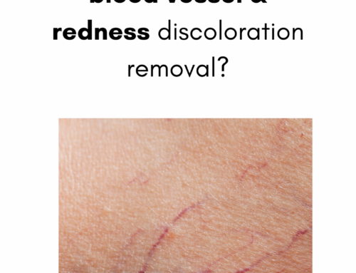 Is there a treatment for blood vessel & redness discoloration removal?