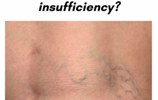Chronic Venous Insufficiency