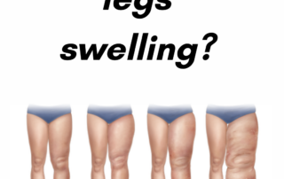 Leg Swelling | Swelling in Your Legs? | Causes, Symptoms & Treatment