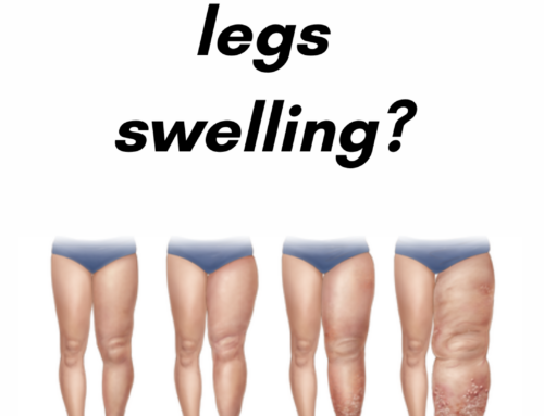 Why are my legs swelling?