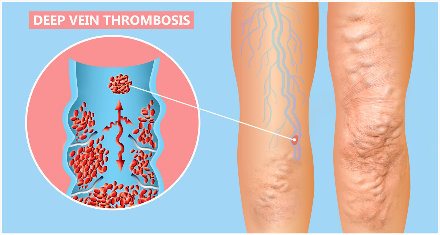 Could I Have a DVT? Learn Signs & Symptoms of Deep Vein Thrombosis