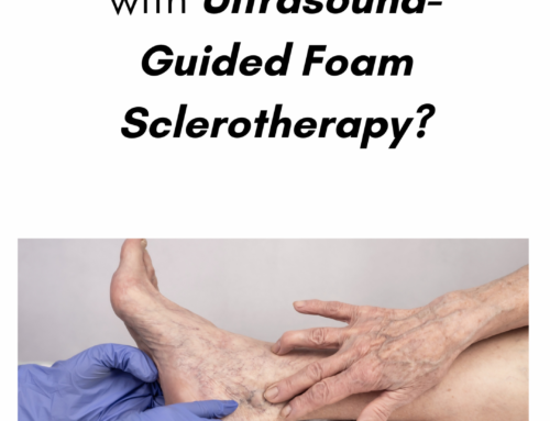 What should I expect with Ultrasound-Guided Foam Sclerotherapy?
