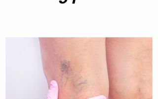 leg pain