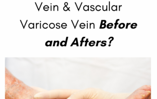 vein