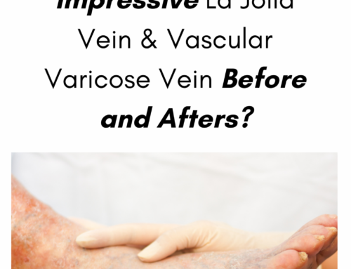 What Are the Most Impressive La Jolla Vein & Vascular Varicose Vein Before and Afters?