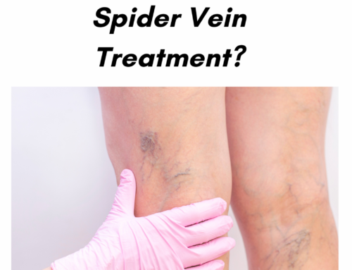 How Can I Expect My Legs to Appear Post-Spider Vein Treatment?