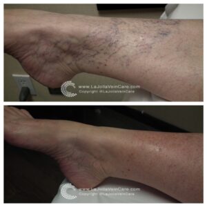 spider | Effective Solutions for Spider Veins: Non-Surgical Treatment