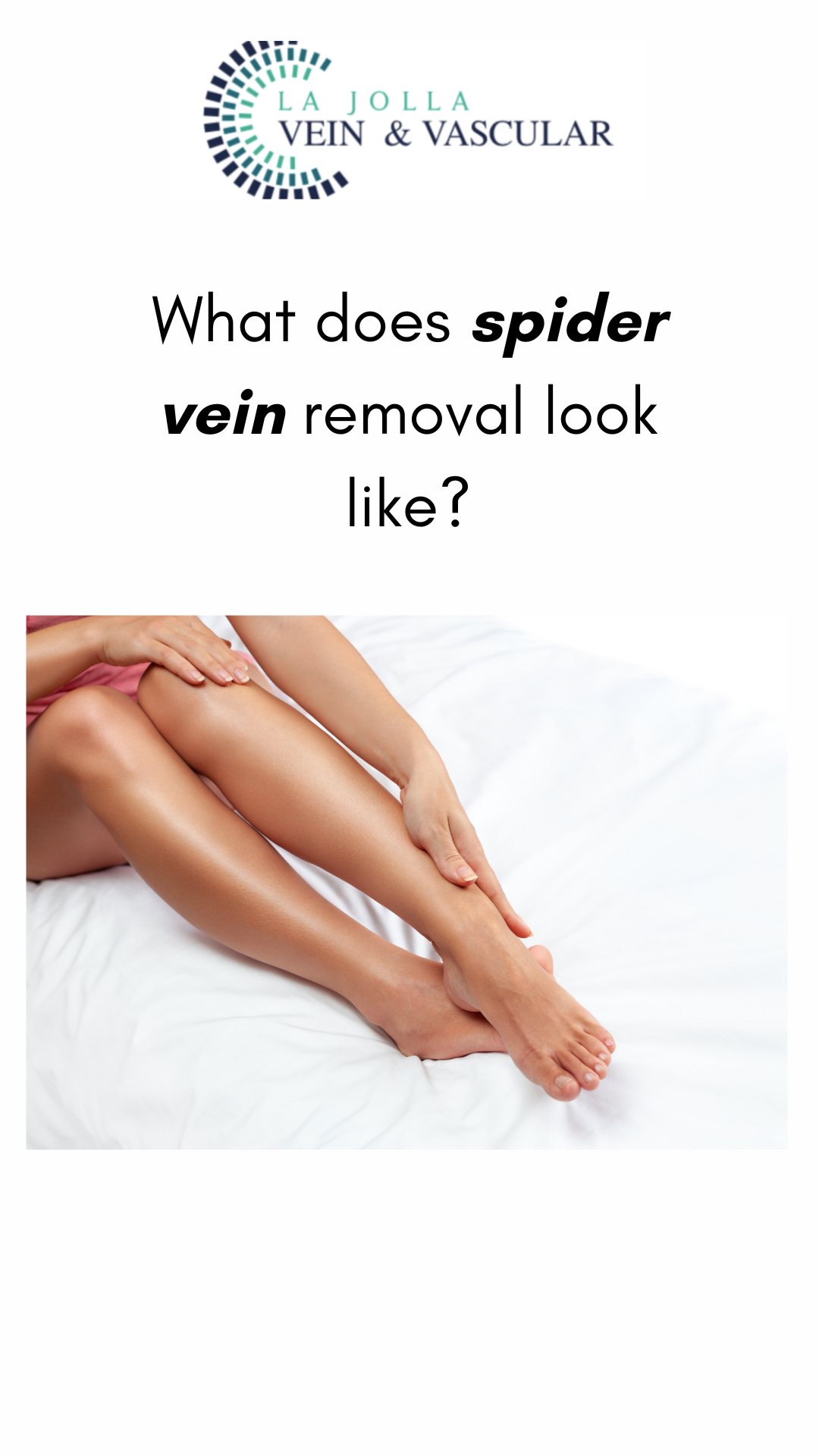 What Does Spider Vein Removal Look Like? – La Jolla Vein Care