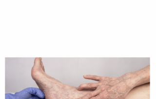 Sclerotherapy Treatment in SD – La Jolla Vein & Vascular