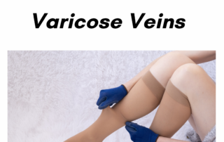 varicose