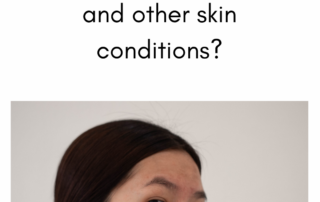 Acne and Skin Care Treatments in San Diego | La Jolla Vein & Vascular