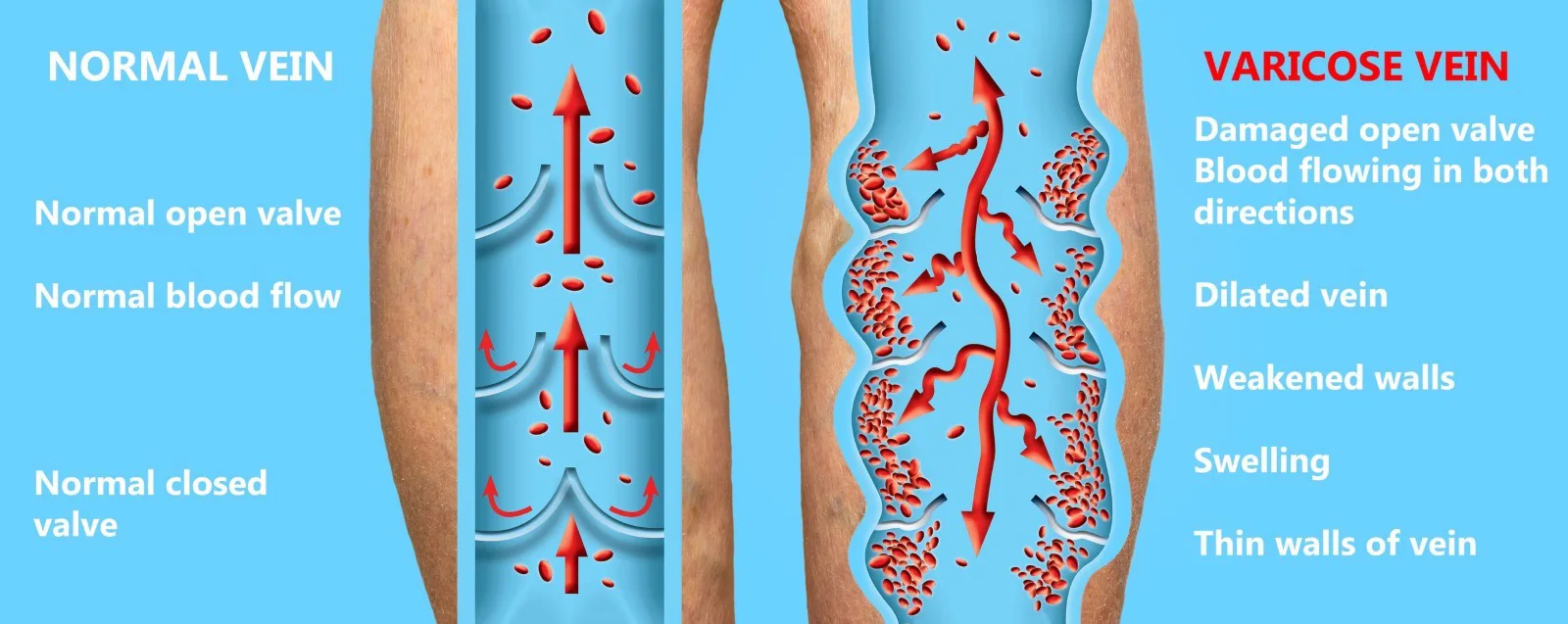 diagram of normal veins in leg vs varicose veins