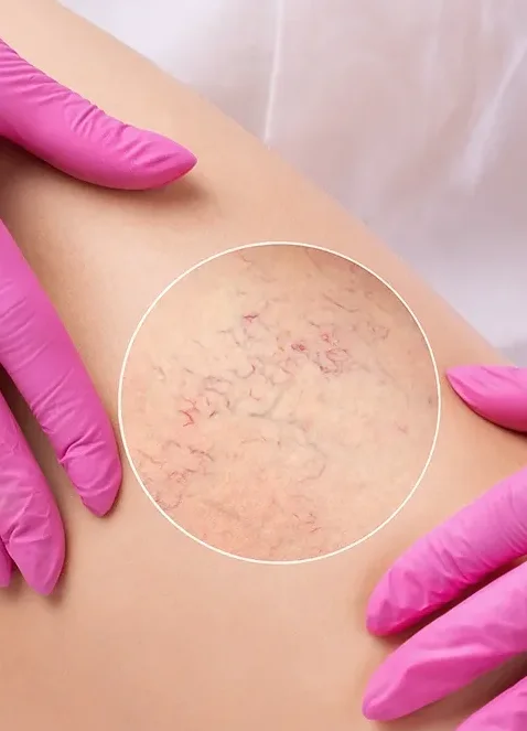 spider veins leg web2